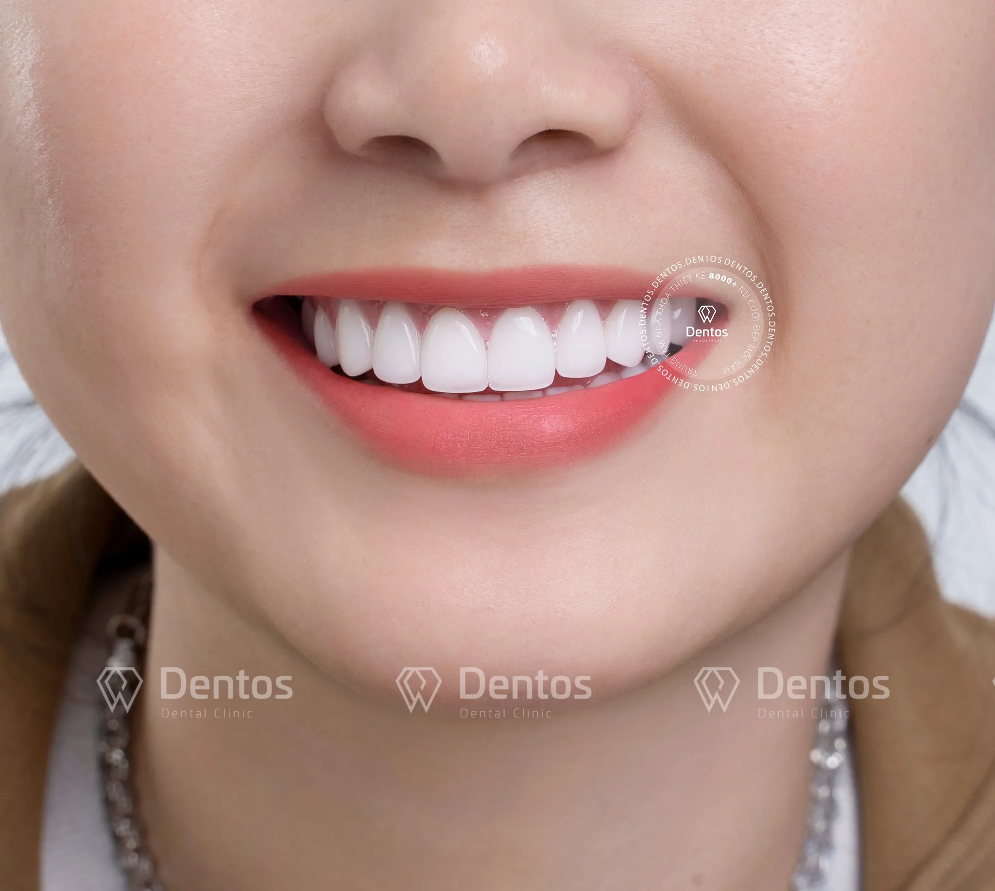 Răng sứ có thể duy trì suốt 10-20 năm, tùy thuộc chất liệu và cách chăm sóc